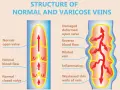 Jämförelse av normala vener med friska klaffar och blodflöde, samt åderbråck med skadade klaffar, omvänt blodflöde och inflammation. Vatten i kroppen kan påverka blodcirkulationen.