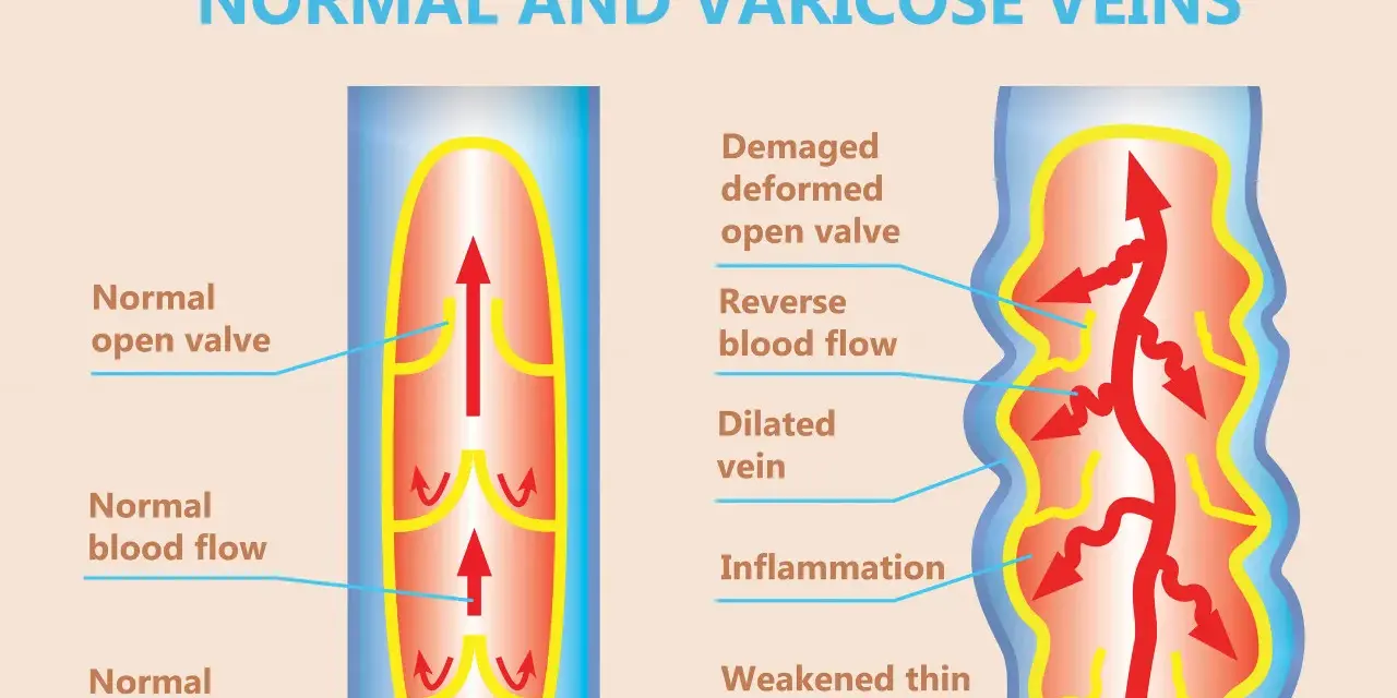 Jämförelse av normala vener med friska klaffar och blodflöde, samt åderbråck med skadade klaffar, omvänt blodflöde och inflammation. Vatten i kroppen kan påverka blodcirkulationen.