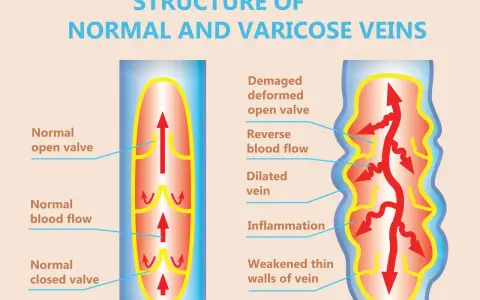 Jämförelse av normala vener med friska klaffar och blodflöde, samt åderbråck med skadade klaffar, omvänt blodflöde och inflammation. Vatten i kroppen kan påverka blodcirkulationen.
