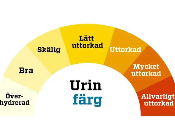 Färgkarta för urin. Mörkare färger indikerar uttorkning, vilket kan leda till illaluktande urin. Allvarligt uttorkad urin kan vara ett tecken på problem, men inte nödvändigtvis illaluktande urin cancer.