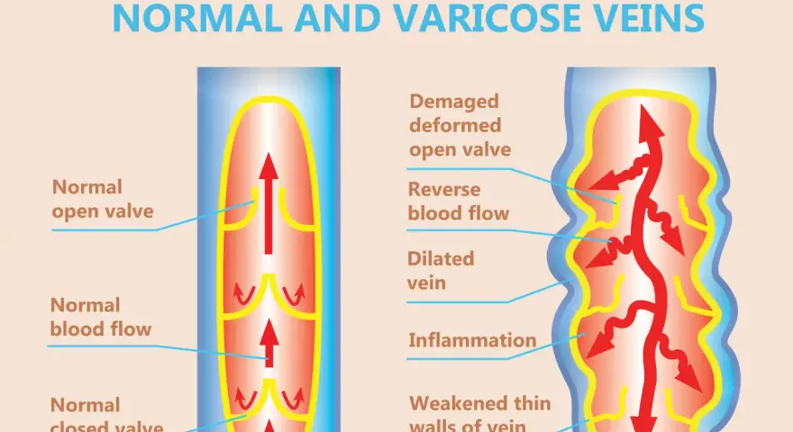 Jämförelse av normala vener med friska klaffar och blodflöde, samt åderbråck med skadade klaffar, omvänt blodflöde och inflammation. Vatten i kroppen kan påverka blodcirkulationen.