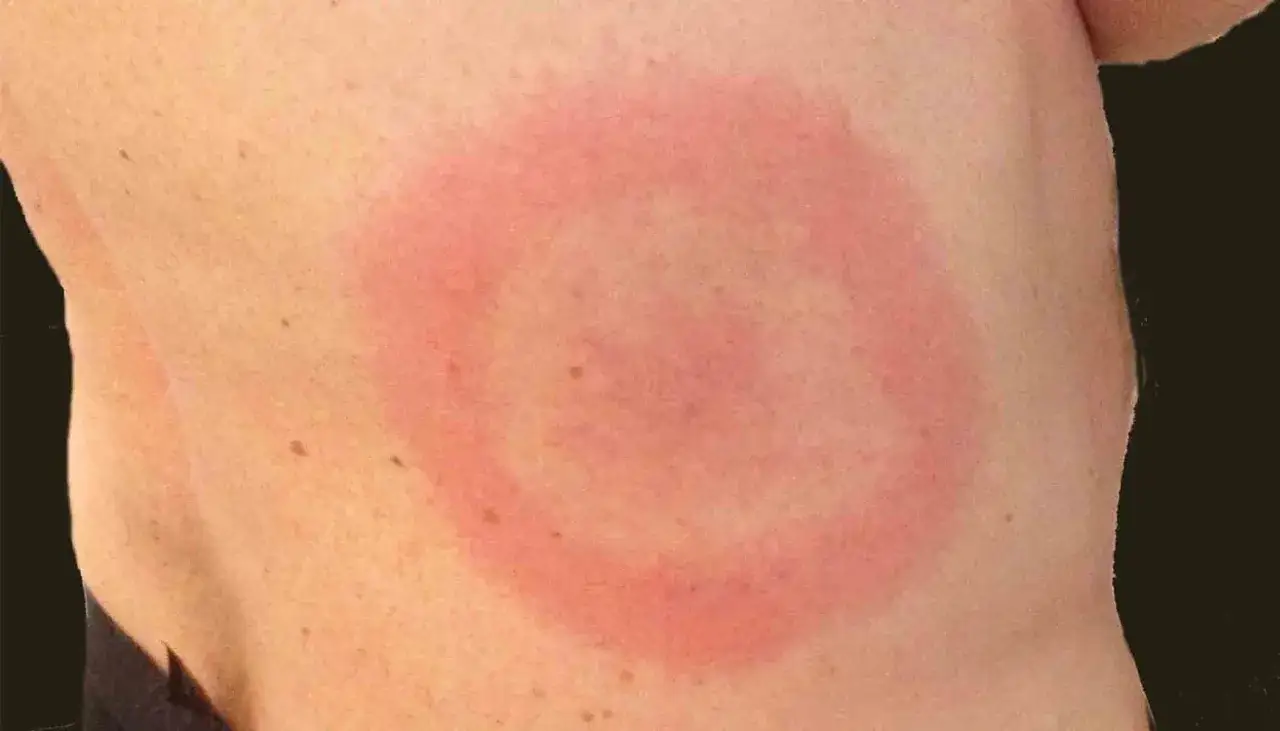 Rodnad ring p&aring; huden som kliar och kryper p&aring; kroppen. Kan vara ett tecken p&aring; borrelia.