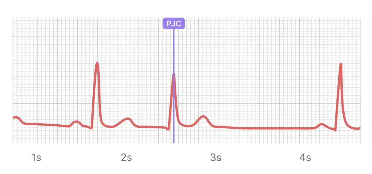 EKG-kurva visar ett PJC, en typ av extraslag. Magnesiumtaurat kan hj&auml;lpa till att stabilisera hj&auml;rtrytmen.
