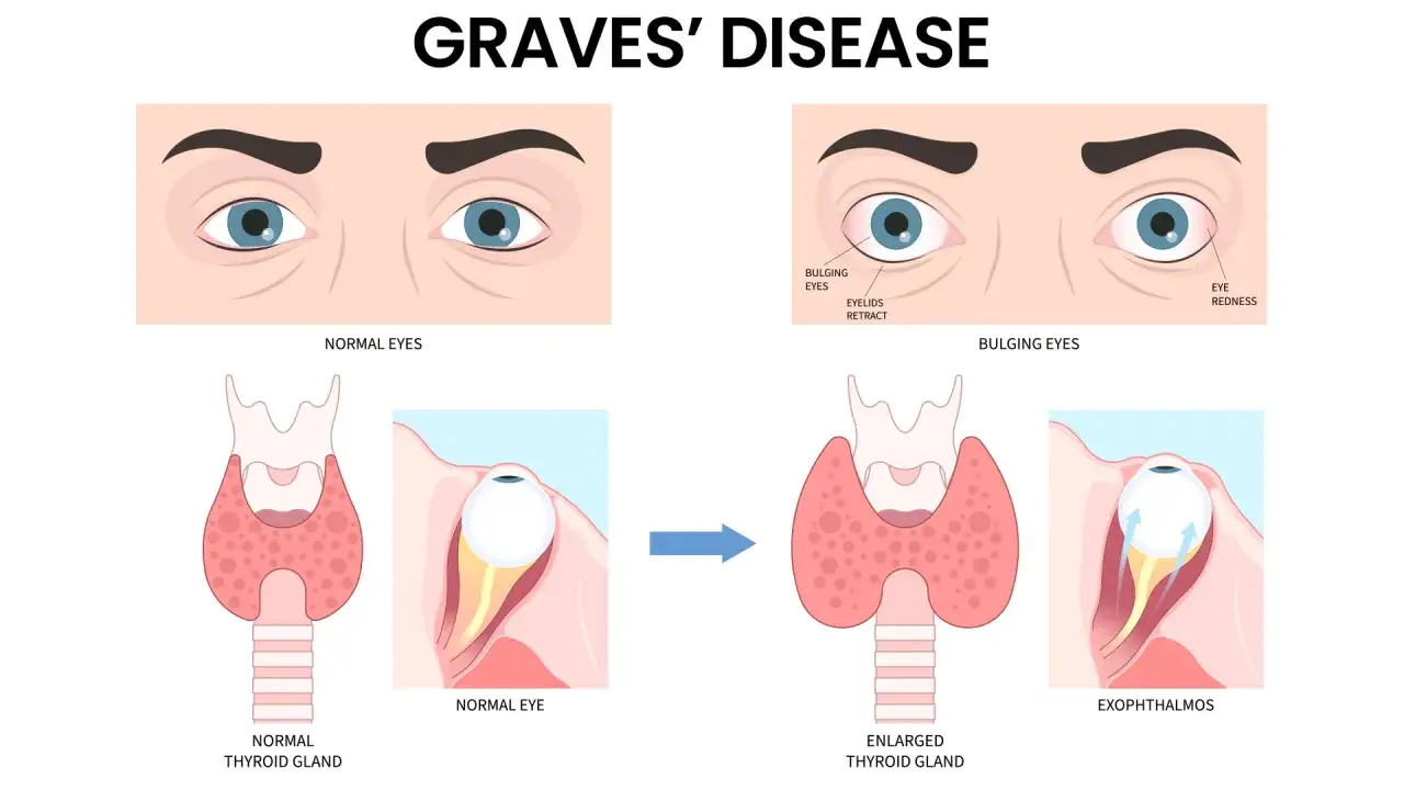Illustration visar hur graves sjukdom påverkar ögonen och sköldkörteln, med utstående ögon och förstorad sköldkörtel.